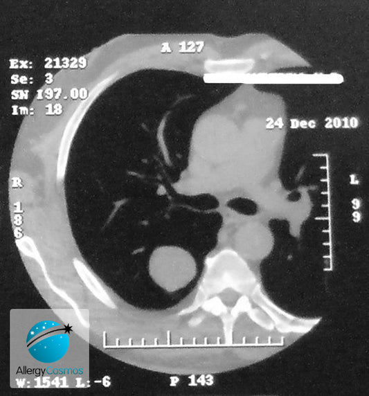 What are the Symptoms of Lung Cancer?