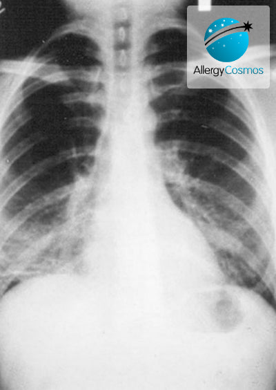 What is Pneumonia?