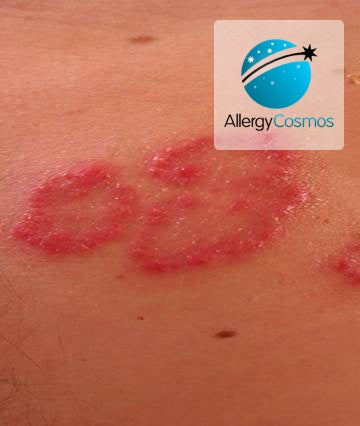 Psoriasis and Diet